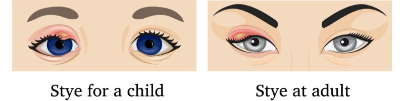 What is a Stye?